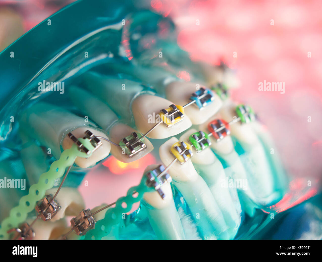 Dental teeth retainers metal aligners brackets to straighten teeth in orthodontic dentistry