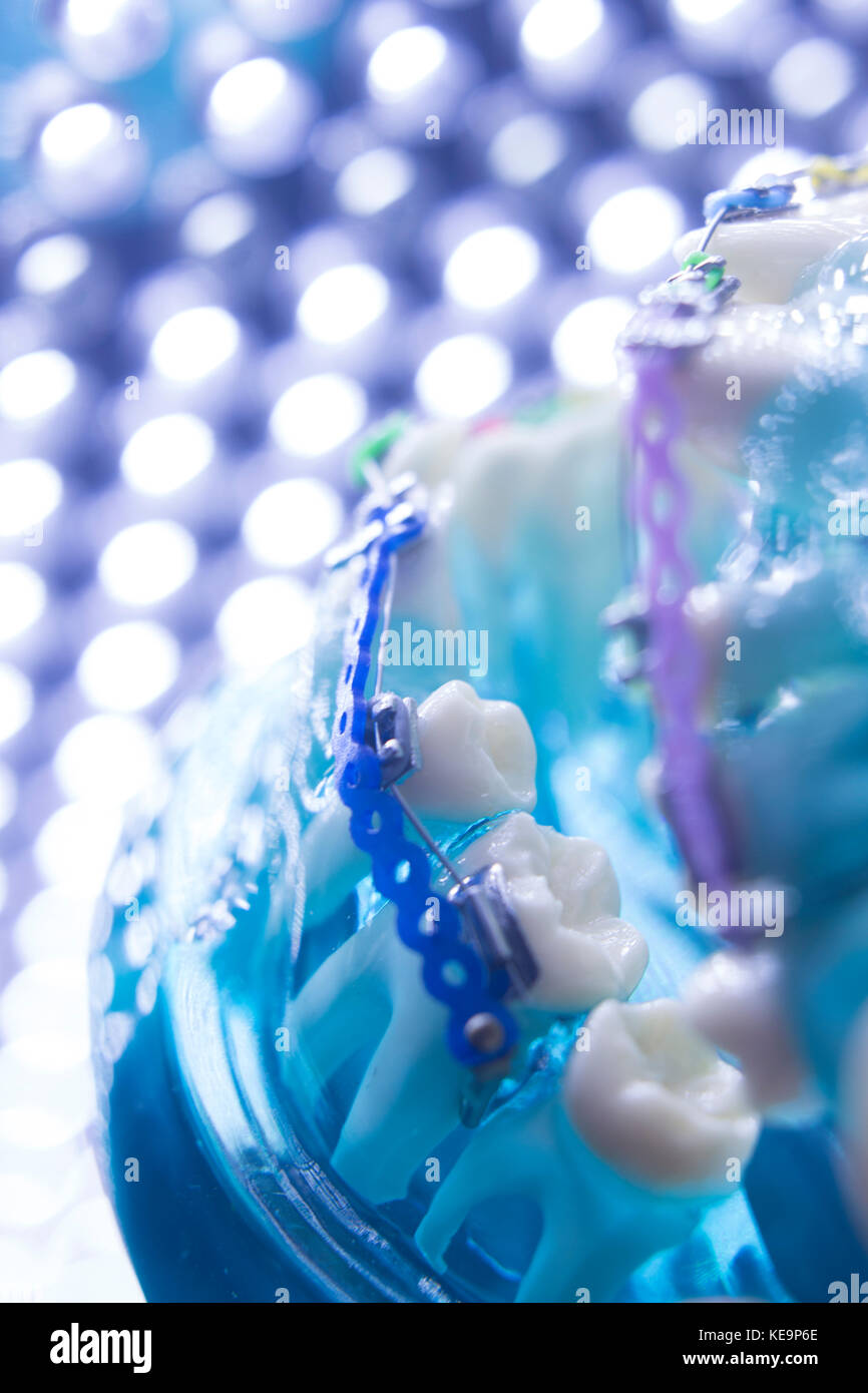 Dental teeth retainers metal aligners brackets to straighten teeth in orthodontic dentistry