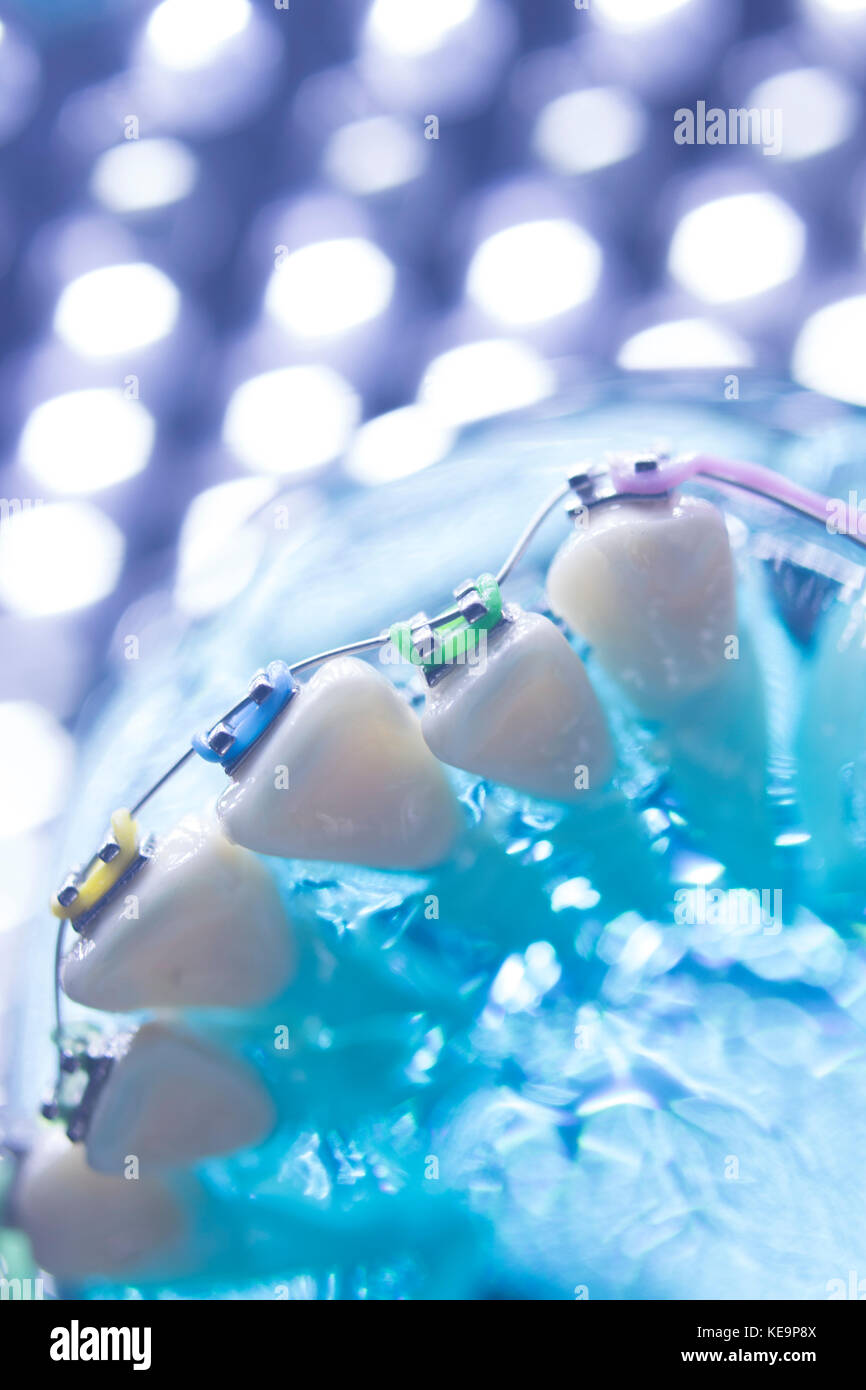 Dental teeth retainers metal aligners brackets to straighten teeth in orthodontic dentistry