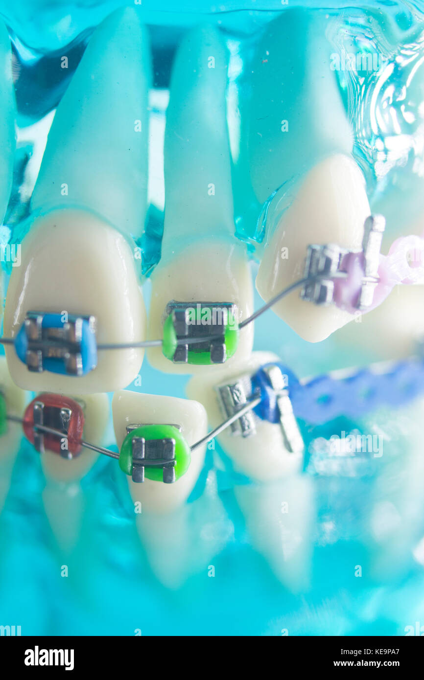 Dental teeth retainers metal aligners brackets to straighten teeth in orthodontic dentistry