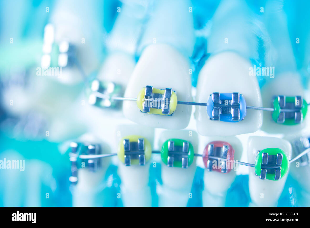 Dental teeth retainers metal aligners brackets to straighten teeth in