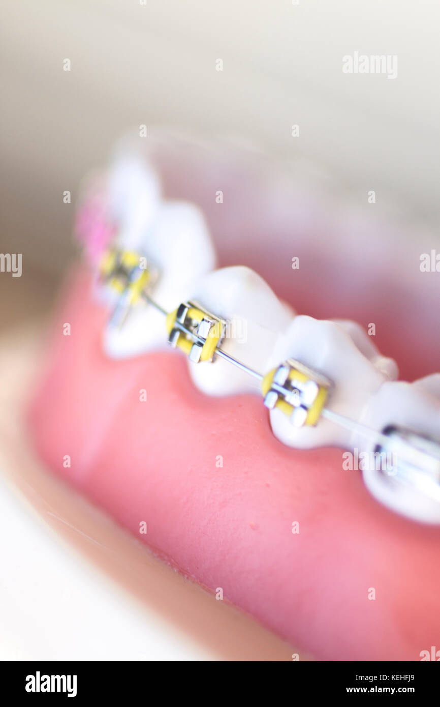 Cosmetic dentistry orthodontics dental metal wire teeth brackets