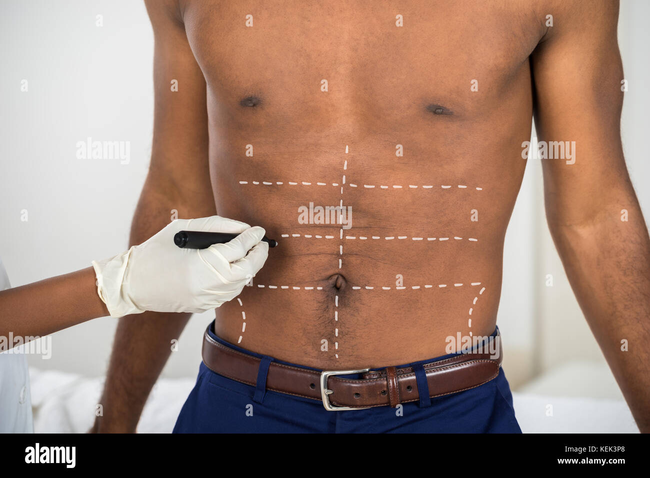 Close-up Of Person's Hand Drawing Correction Lines On Abdomen Of African Man Stock Photo