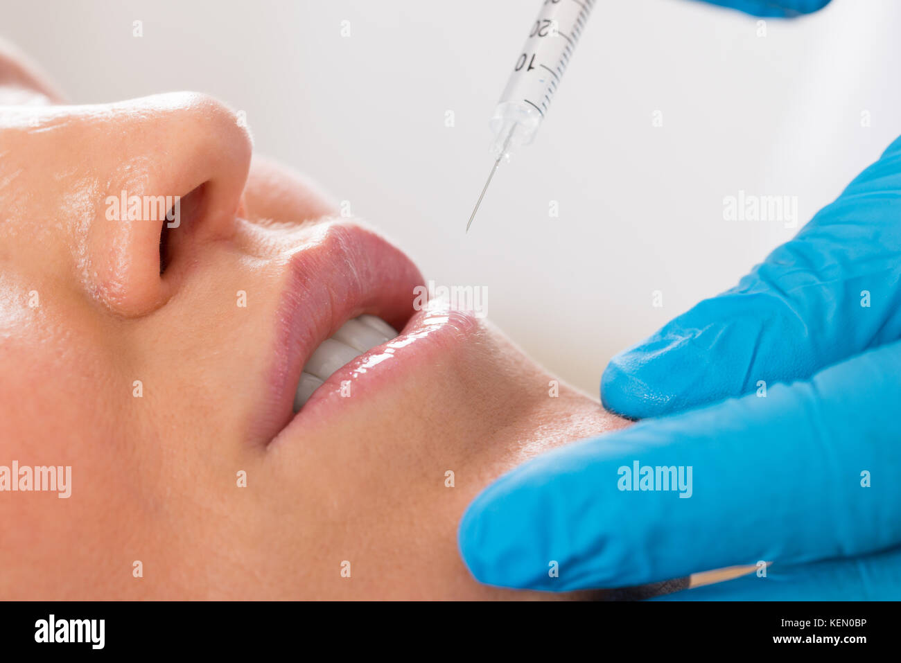 Close-up Of Woman Receive Cosmetic Injection With Syringe On Lip Stock Photo
