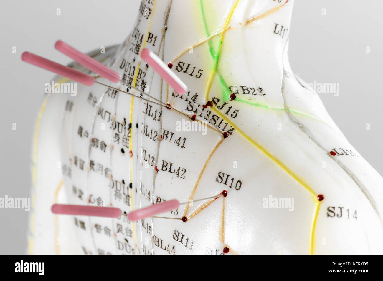 female acupuncture model with needles in the shoulder Stock Photo Alamy