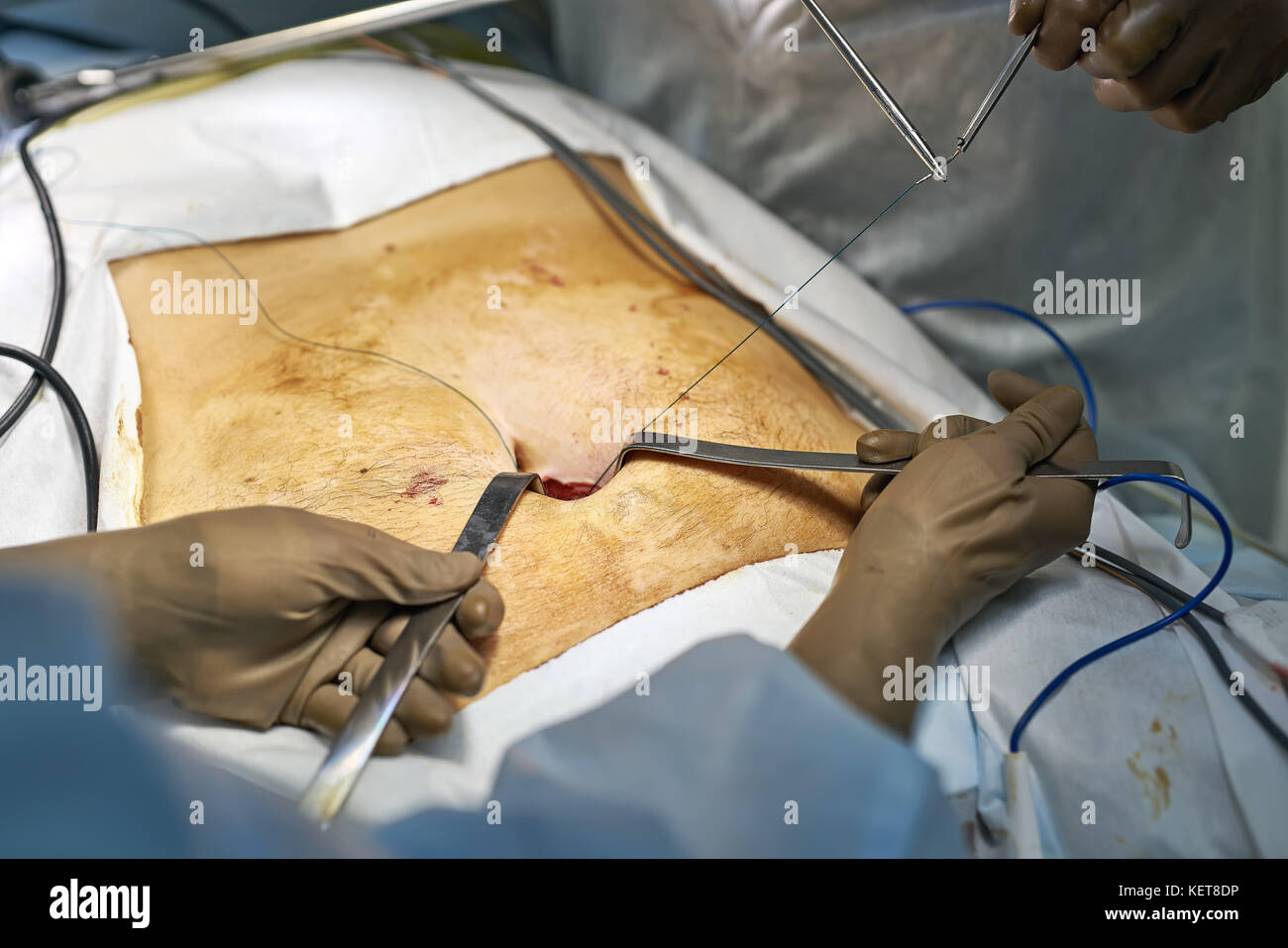 Doctor is using a suture with needle holder while assistant is using surgical retractors to expand the hole on the patient's stomach. This is a laparo Stock Photo