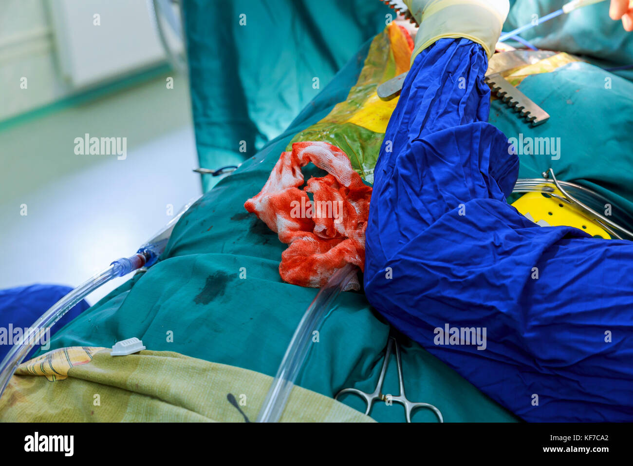 Surgeon doctor operating wearing special lamp lighting using electric cautery heart surgery intervention close-up, open cord surgery minimally invasiv Stock Photo