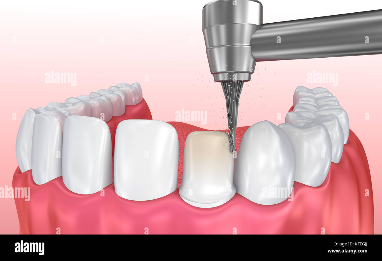 Dental Veneers: Porcelain Veneer installation Procedure. 3D illustration Stock Photo