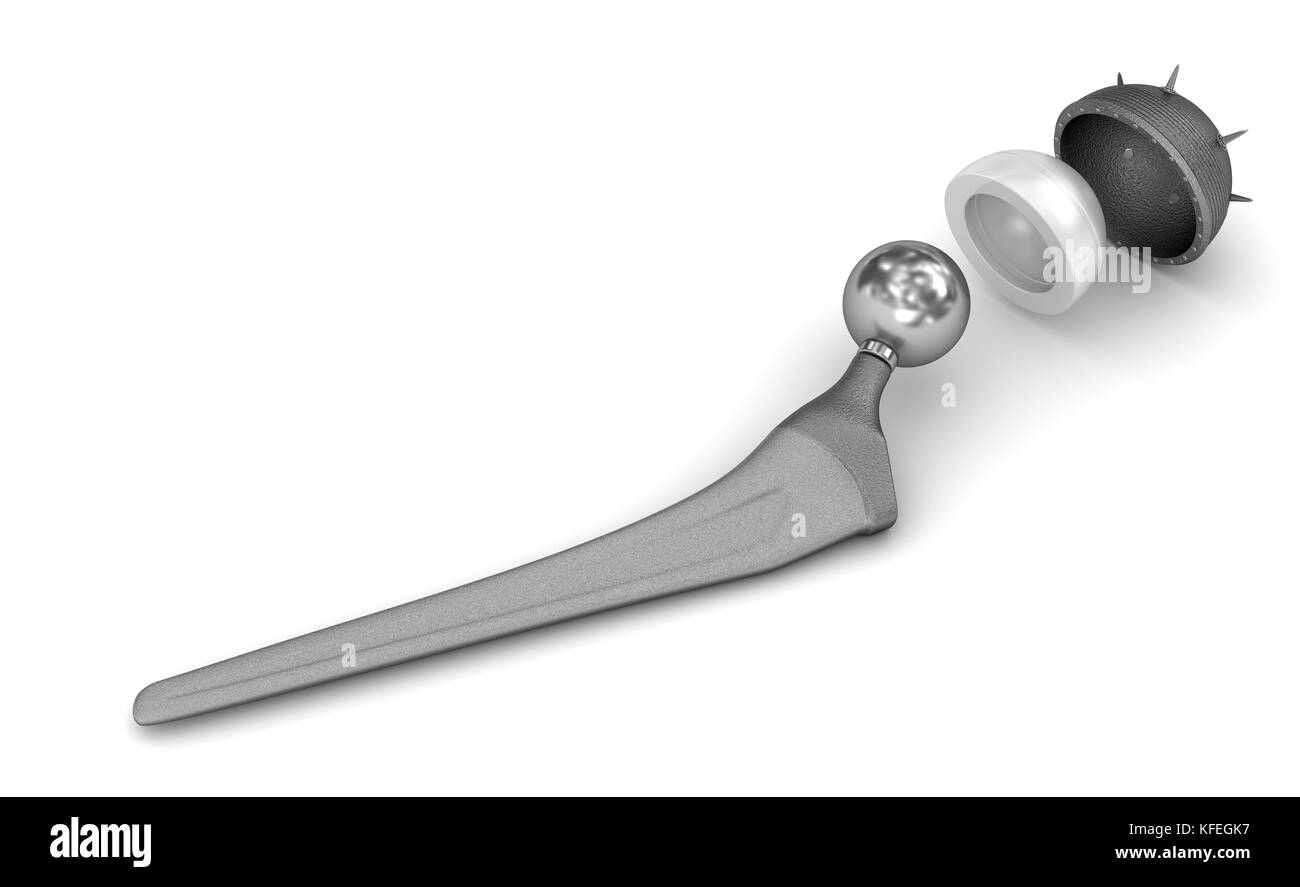 Hip replacement implant isolated on white. Medically accurate 3D illustration Stock Photo Alamy