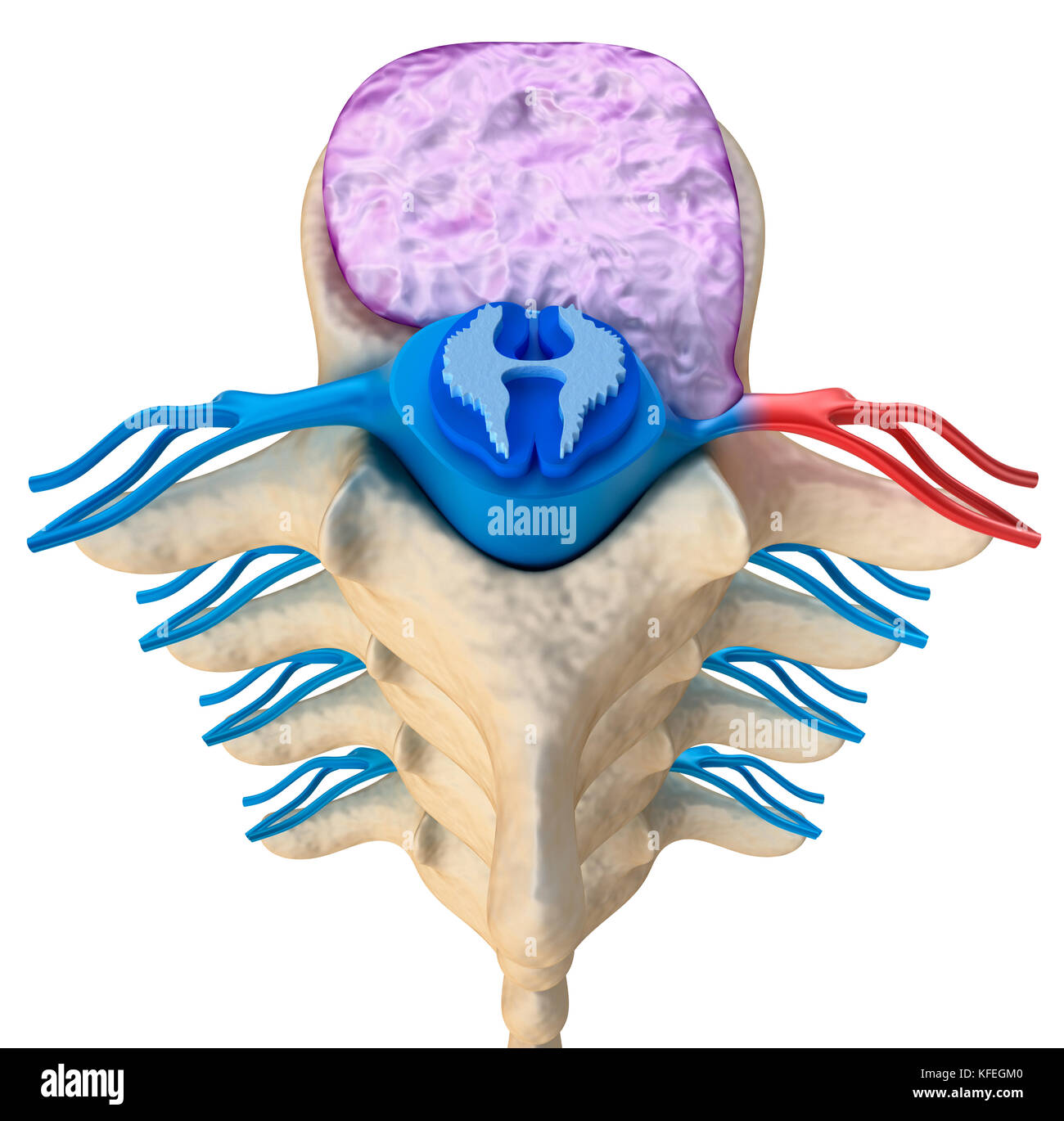 Spinal cord under pressure of bulging disc, 3D illustration Stock Photo