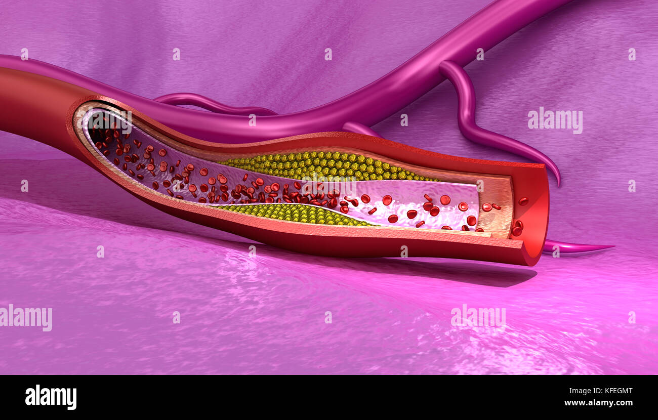 Cholesterol plaque in blood vessel , Medically accurate 3D illustration