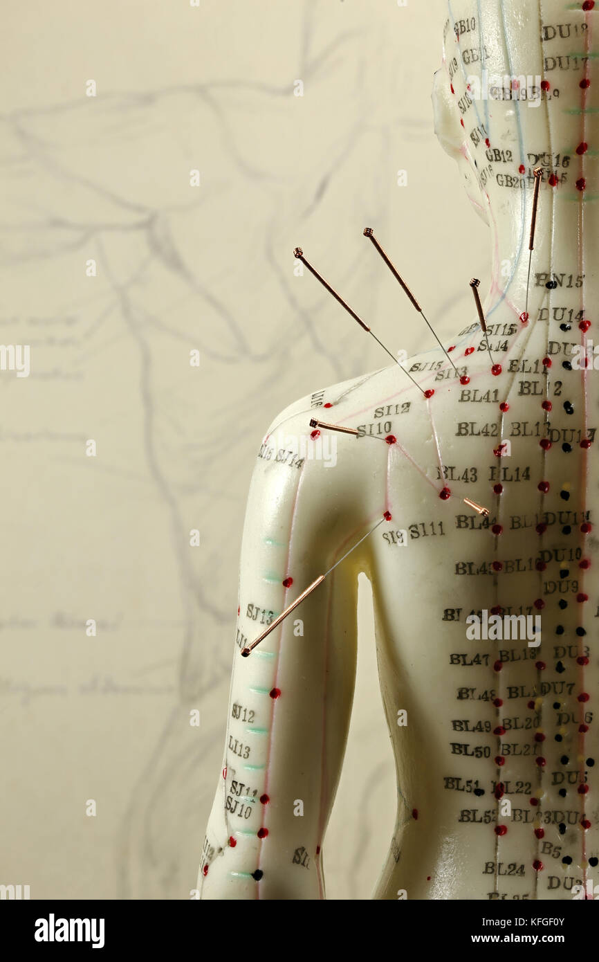female acupuncture model with needles in the shoulder Stock Photo Alamy
