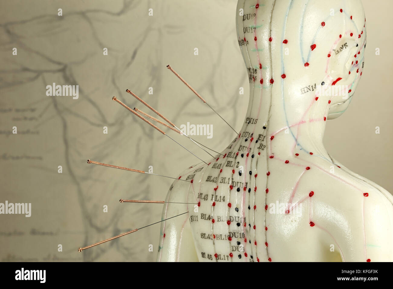 female acupuncture model with needles in the shoulder Stock Photo Alamy