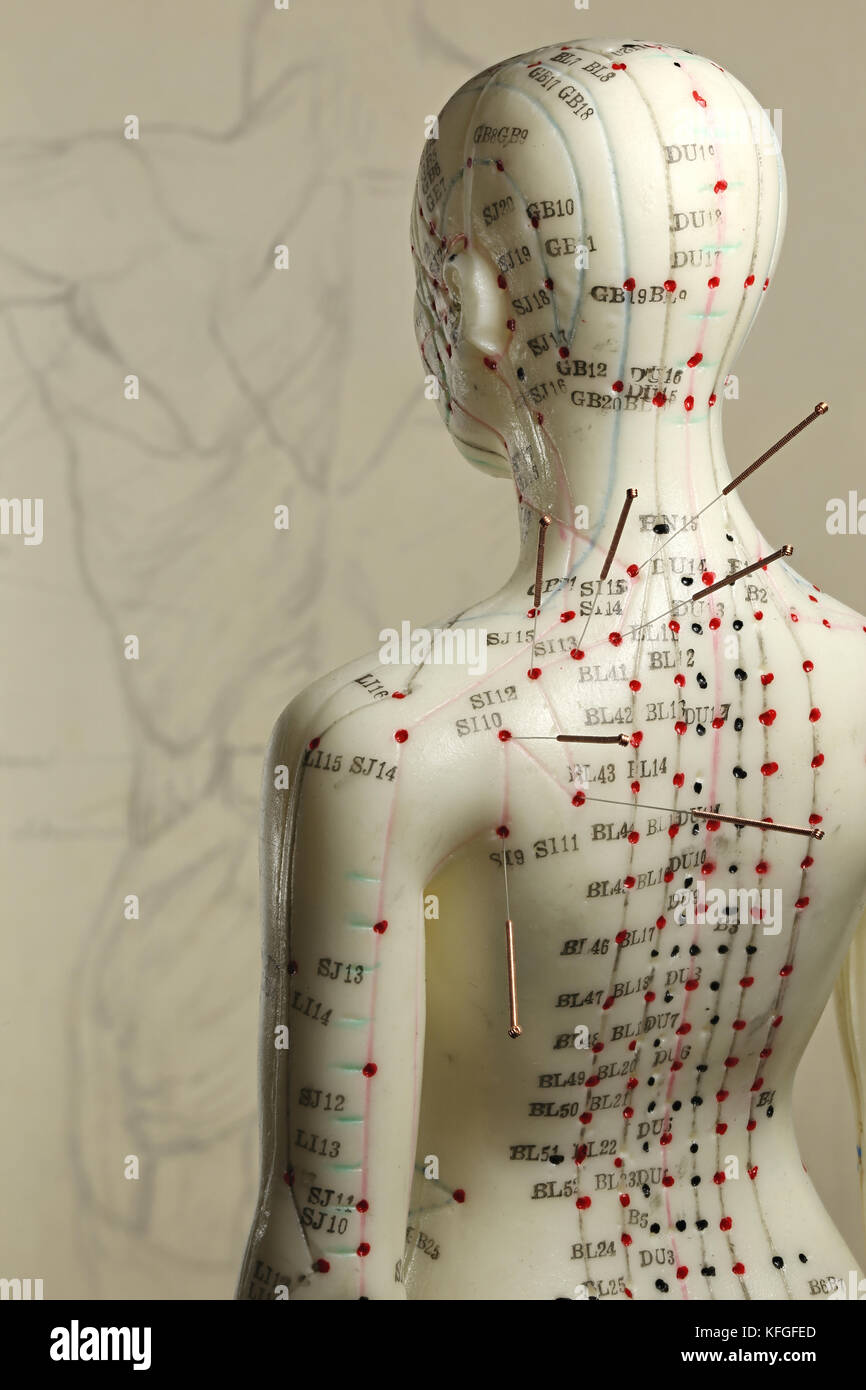 Female Acupuncture Model With Needles In The Shoulder Stock Photo Alamy