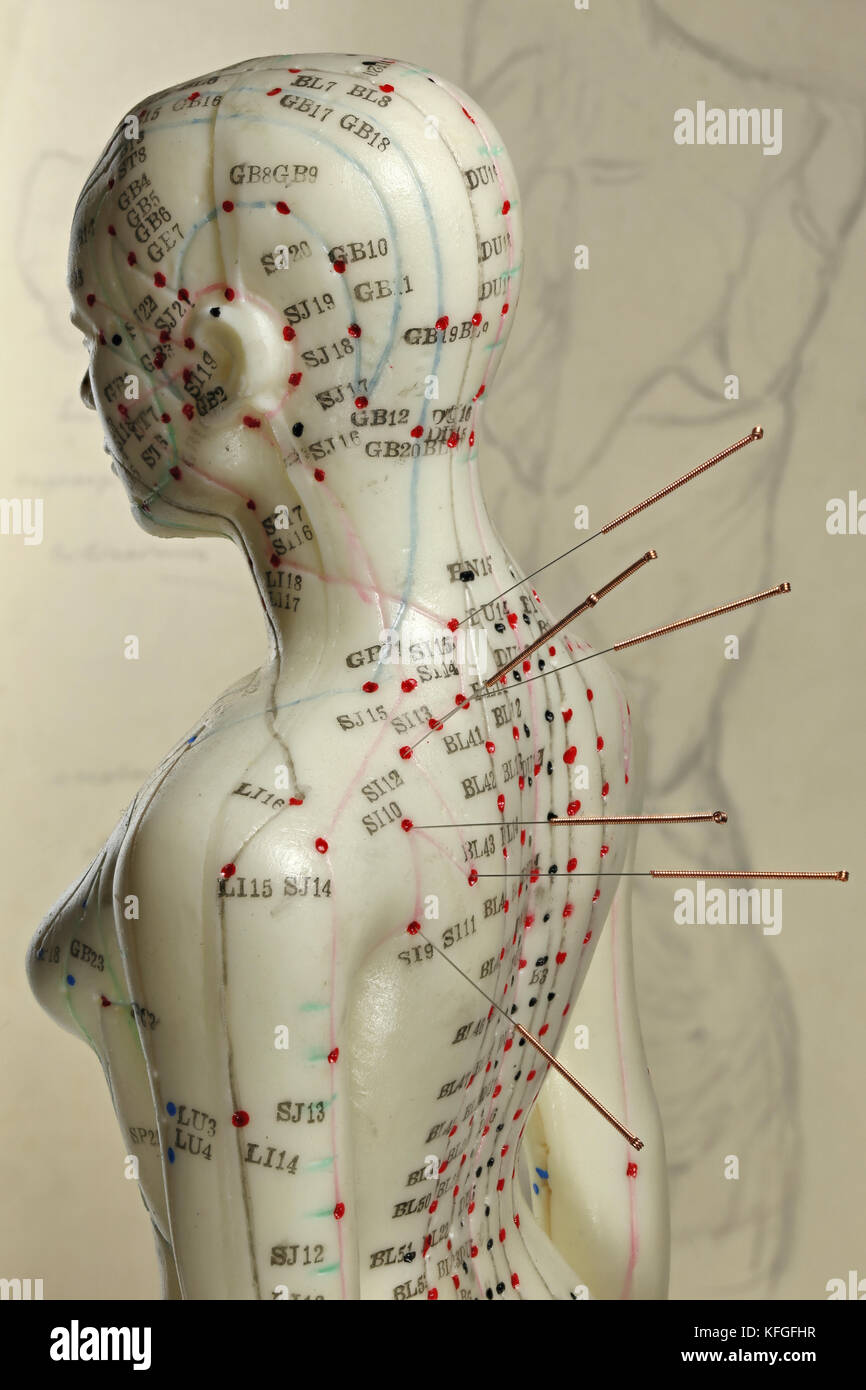 female acupuncture model with needles in the shoulder Stock Photo Alamy