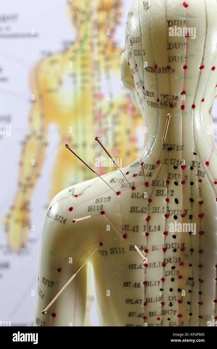 female acupuncture model with needles in the shoulder Stock Photo Alamy