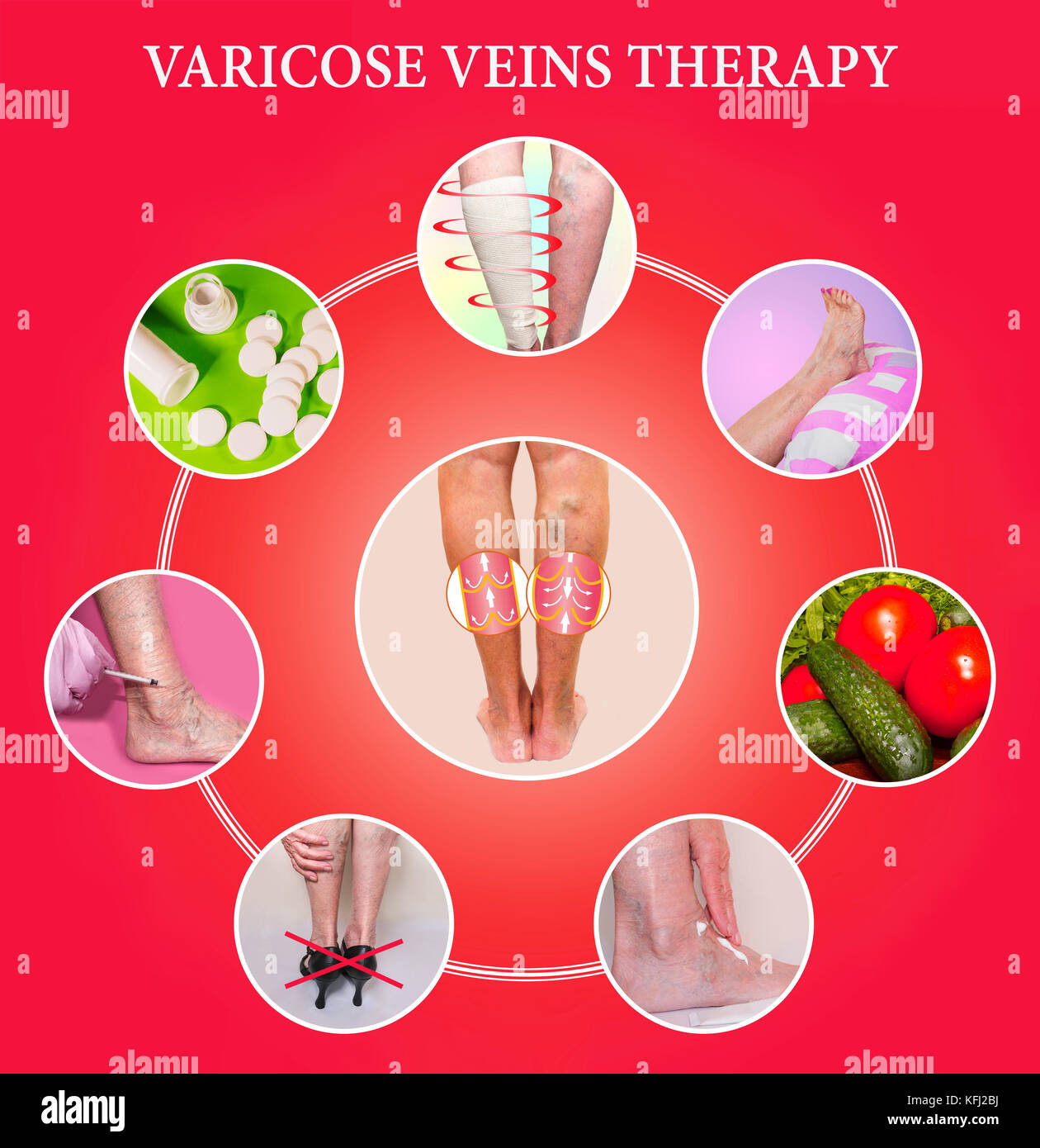 Treatment of varicose veins Stock Photo Alamy