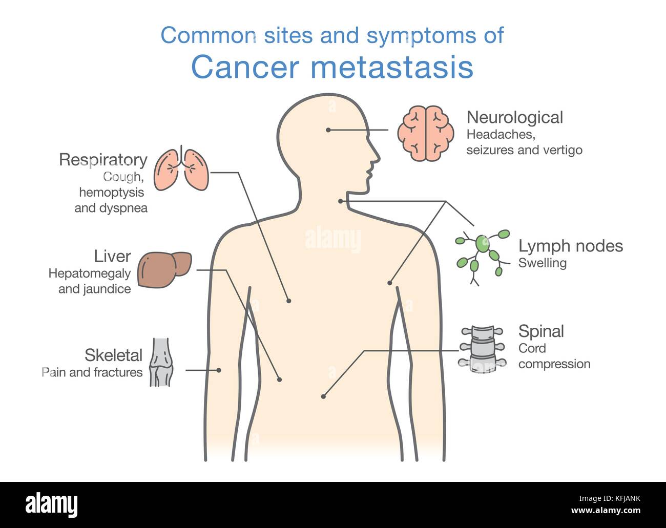 Most common sites and symptoms of Cancer Metastasis. Stock Vector