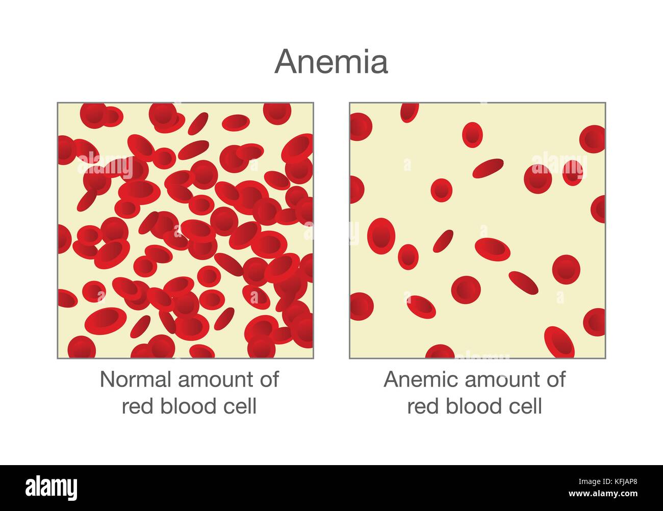 The difference of normal amount of red blood cell and Anemia. Stock Vector