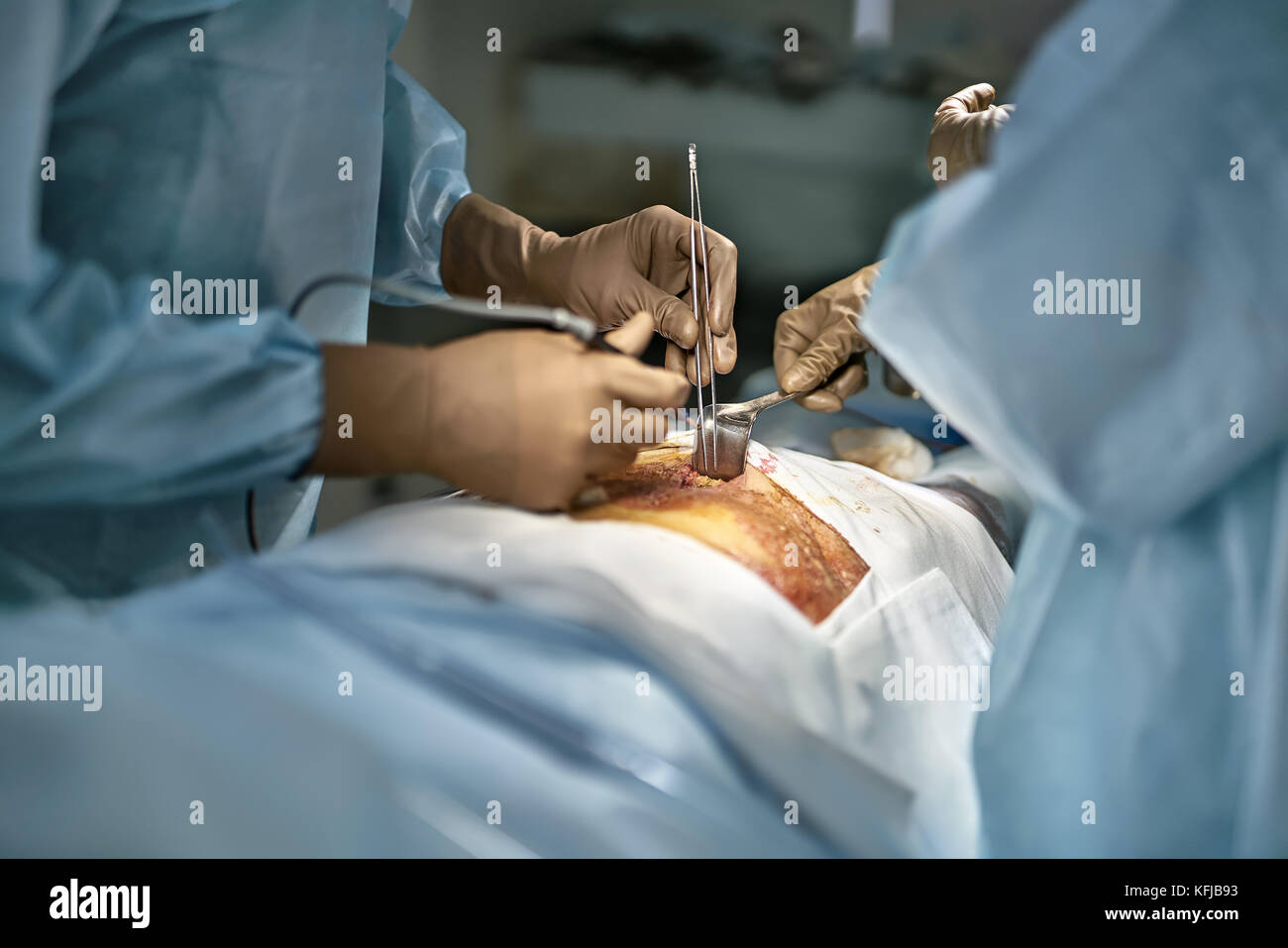 Assistant is holding a surgical retractor while doctor is using a laser