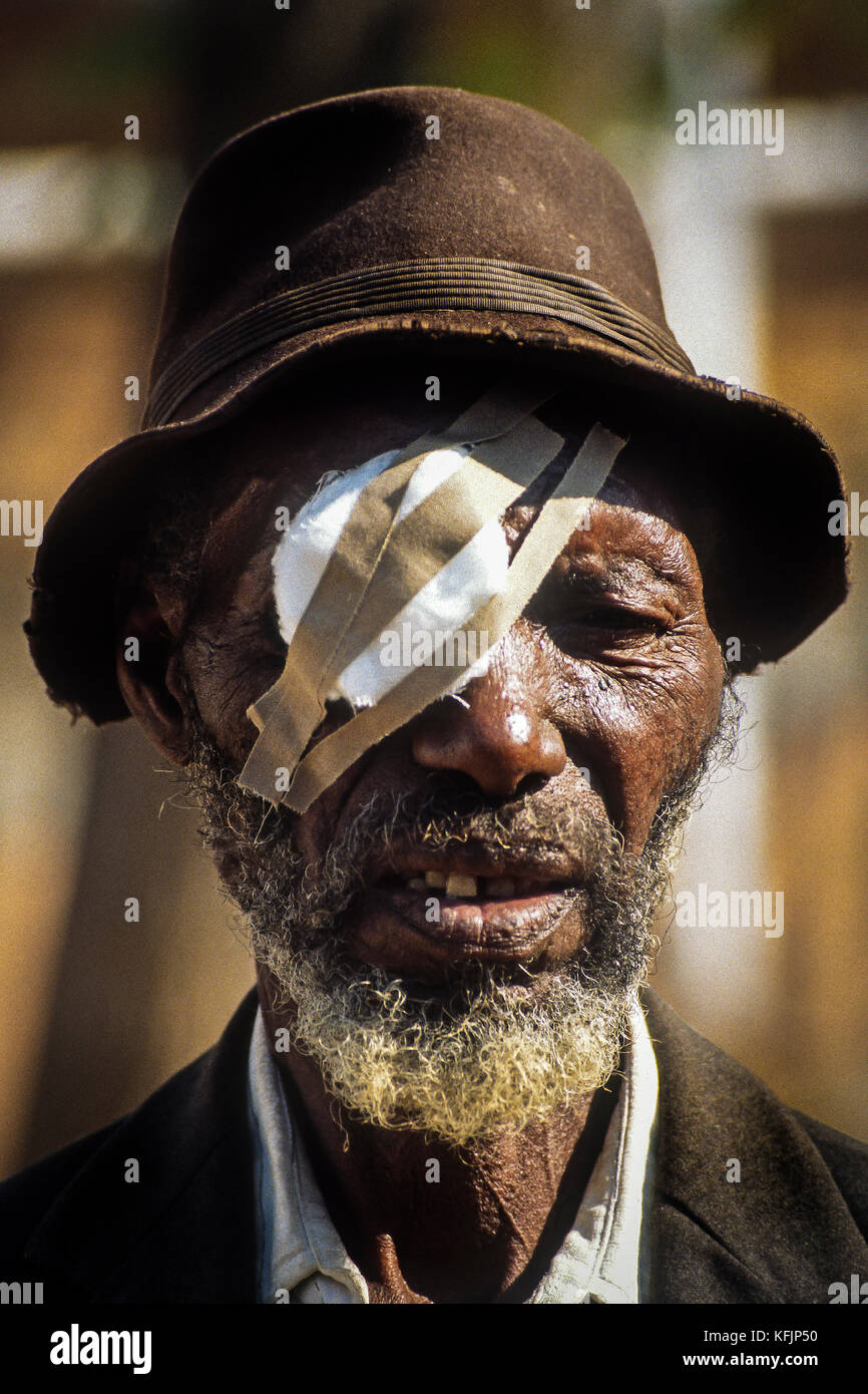 Eye Surgery, Zimbabwe, Southern Africa.  Raleigh International partnered Surgical Eye Expeditions(SEE) International on a number of expeditions to assist in the provision of medical, surgical, and educational services with the primary objective of restoring sight to blind individuals. Stock Photo