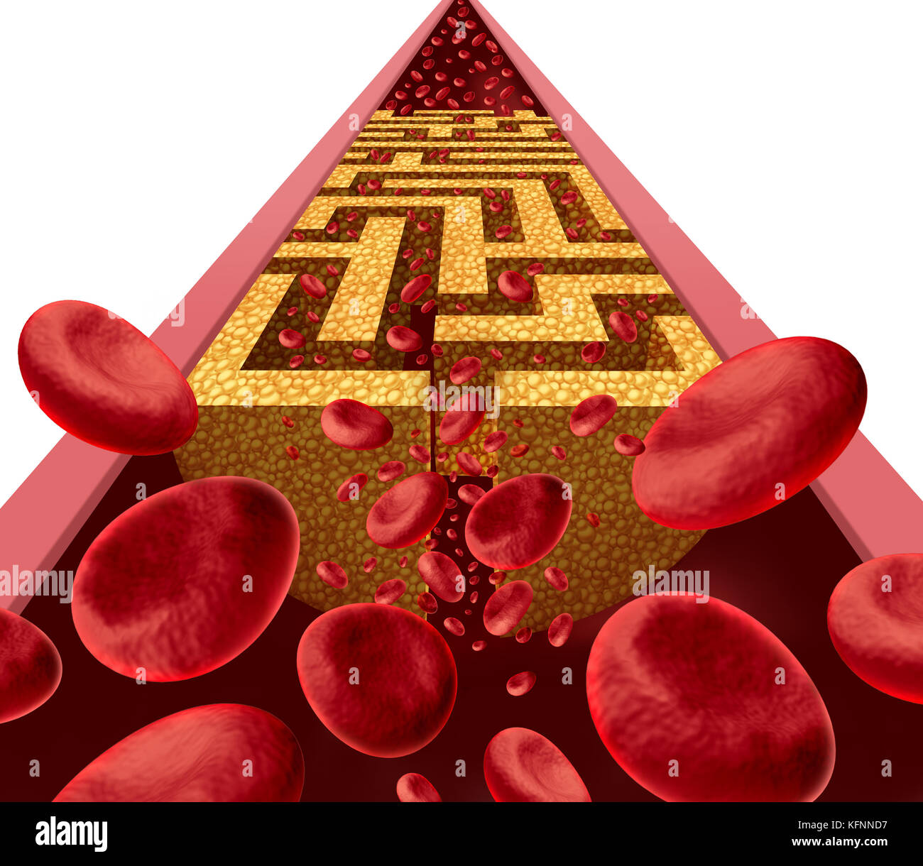 Cholesterol disease challenge and clogged artery medical coronary health risk as a blockage in arteries shaped as a maze or labyrinth with narrow. Stock Photo