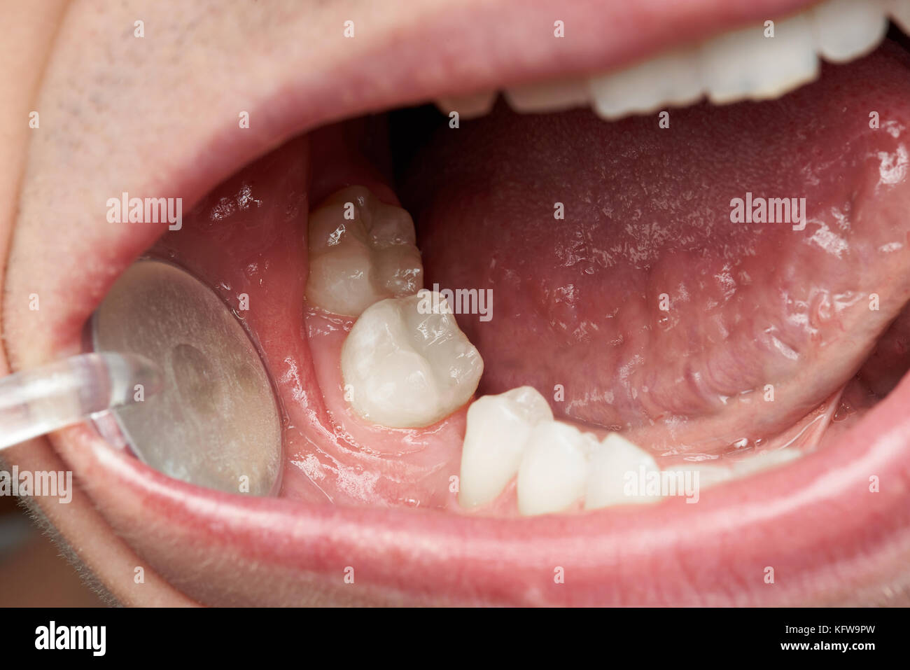 Macro of space without tooth in patient mouth. Dental theme Stock Photo
