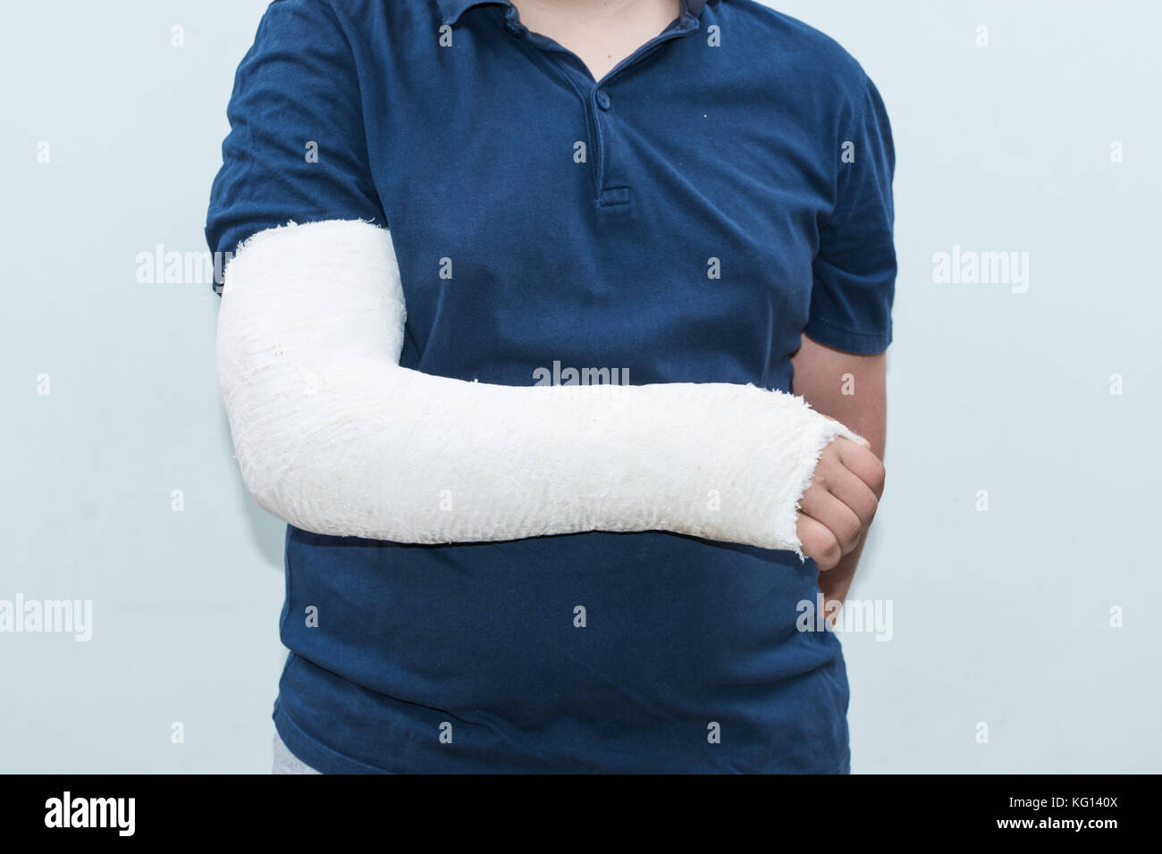Boy with broken arm, plaster on arm as therapy. Close up of a young man's white long arm plaster / fiberglass cast covering the wrist, arm, and elbow  Stock Photo