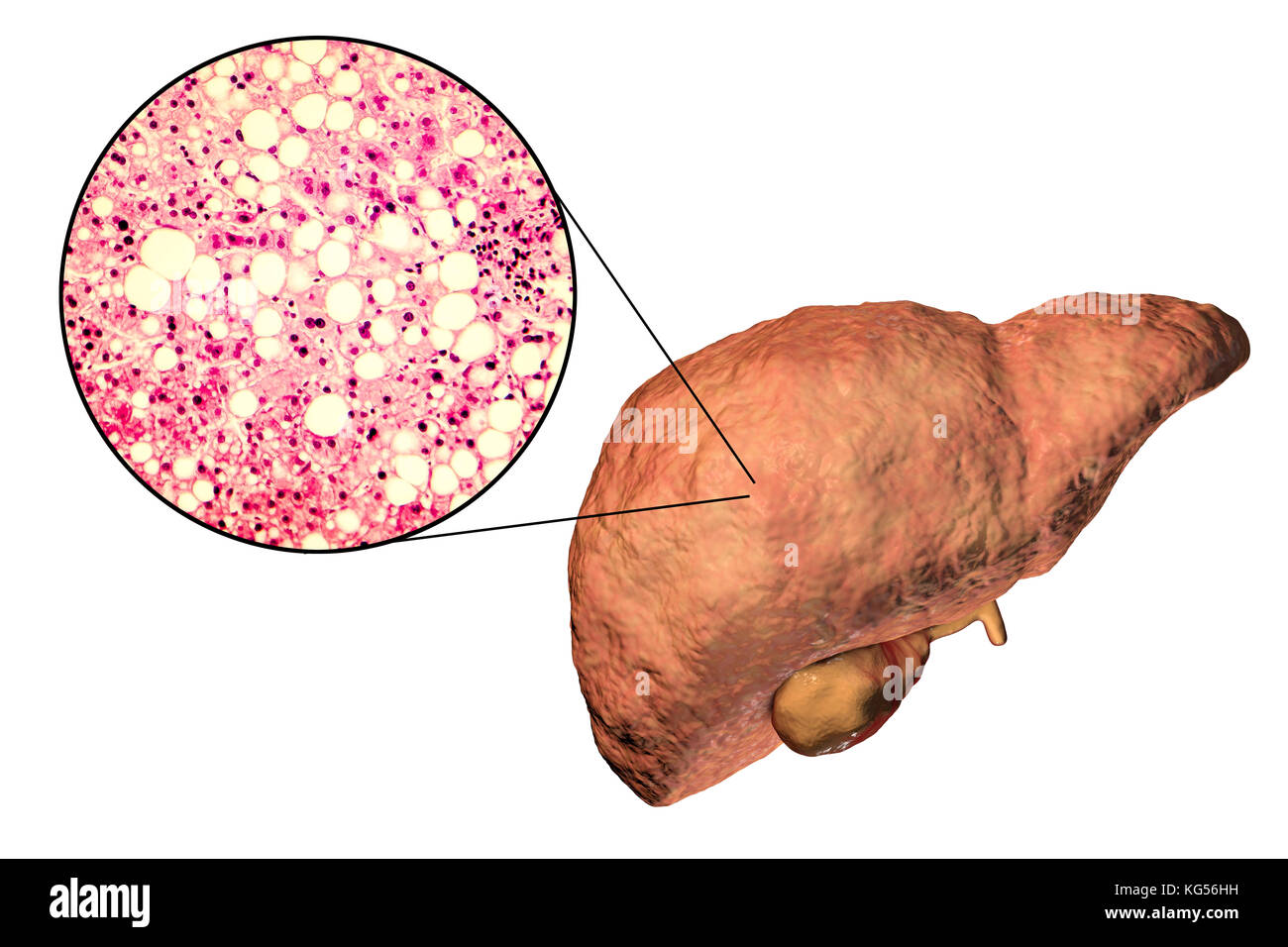 Fatty liver. Computer illustration and light micrograph of a section through the liver of a patient with fatty liver disease. Fatty liver is commonly associated with alcohol or metabolic syndrome (diabetes, hypertension and obesity), but can also be due to any one of many causes. Fatty liver disease is a reversible condition wherein large vacuoles of fat (pale yellow circles) accumulate in liver cells. Stock Photo