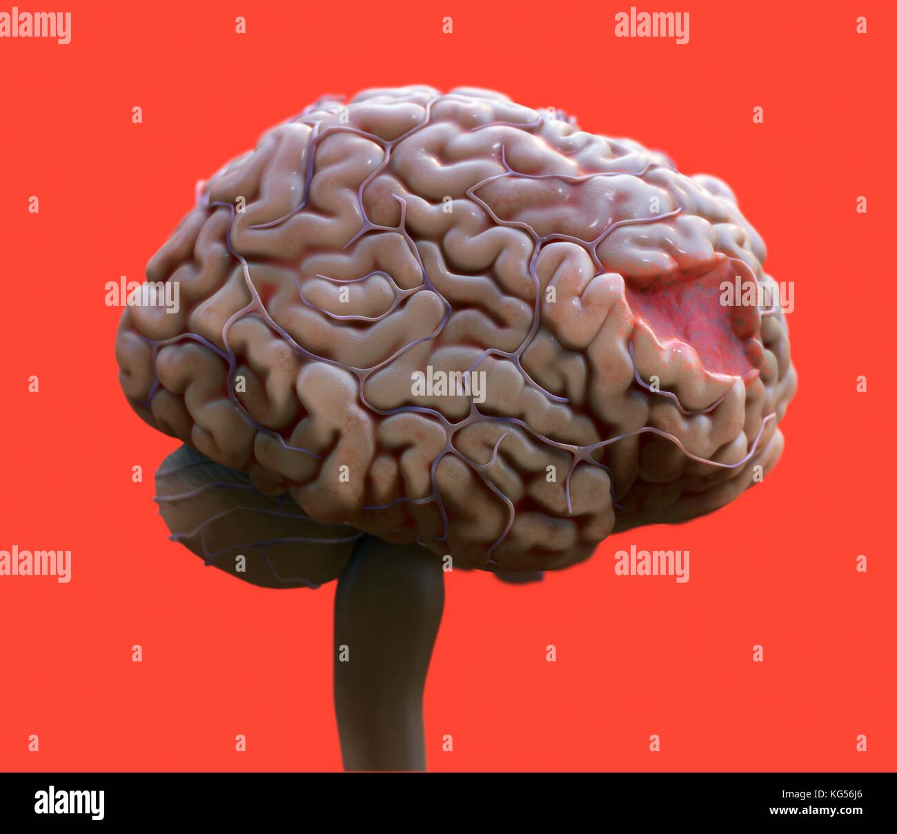 Brain damage hires stock photography and images Alamy