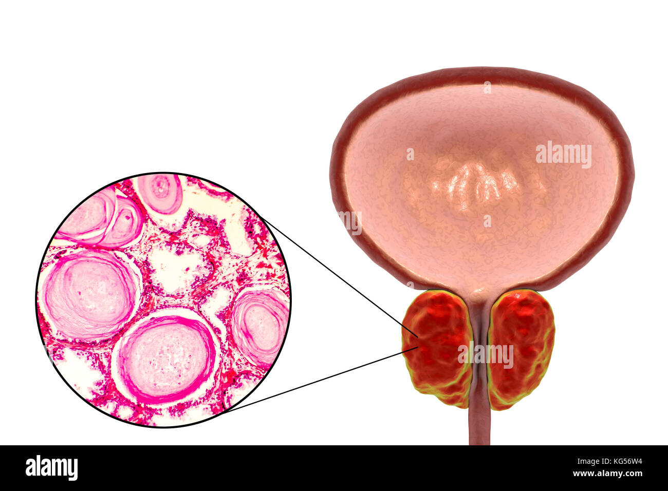 Light micrograph (left) and computer illustration (right) showing benign prostatic hyperplasia. Hyperplasia describes an increase in cell numbers due to cell division. In the prostate gland, the inner portion and its surrounding fibromuscular stroma may become hyperplastic. Here, the acini (white spaces) are lined with tall cells with small basal nuclei; the glandular lining appears buckled into papillary folds (seen in upper right part of micrograph). Adjacent acini are separated by thickened fibromuscular connective tissue. Stock Photo