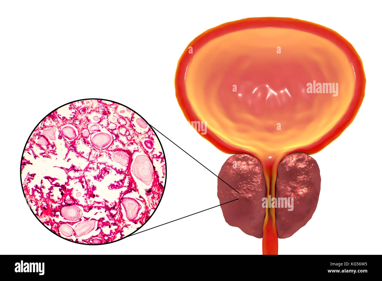 Light micrograph (left) and computer illustration (right) showing benign prostatic hyperplasia. Hyperplasia describes an increase in cell numbers due to cell division. In the prostate gland, the inner portion and its surrounding fibromuscular stroma may become hyperplastic. Here, the acini (white spaces) are lined with tall cells with small basal nuclei; the glandular lining appears buckled into papillary folds (seen in the centre of micrograph). Adjacent acini are separated by thickened fibromuscular connective tissue. There is cystic dilatation with accumulation of secretory material. Stock Photo