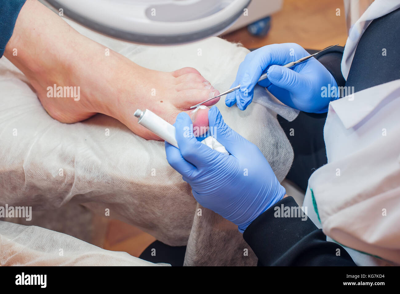 Podology treatment. Podiatrist treating toenail fungus. Doctor removes