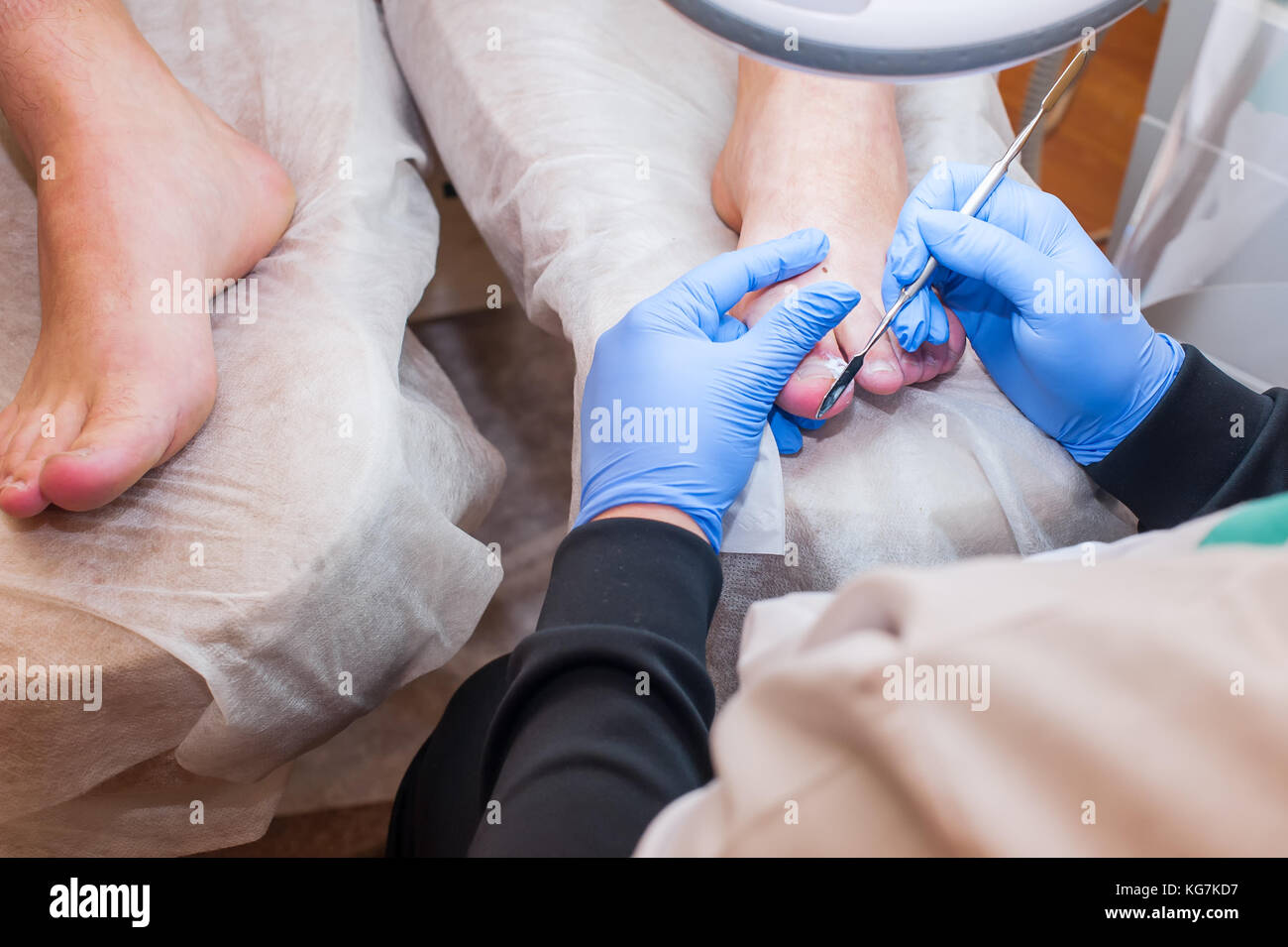 Podology treatment. Podiatrist treating toenail fungus. Doctor removes