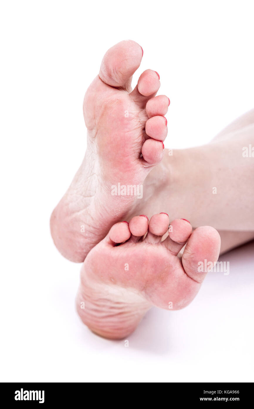 dry dehydrated skin on the heels of female feet with calluses Stock