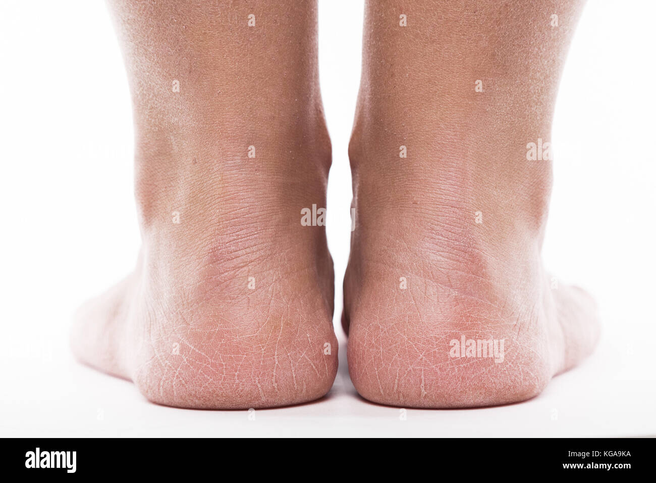 dehydrated skin on the heels of female feet Stock Photo Alamy