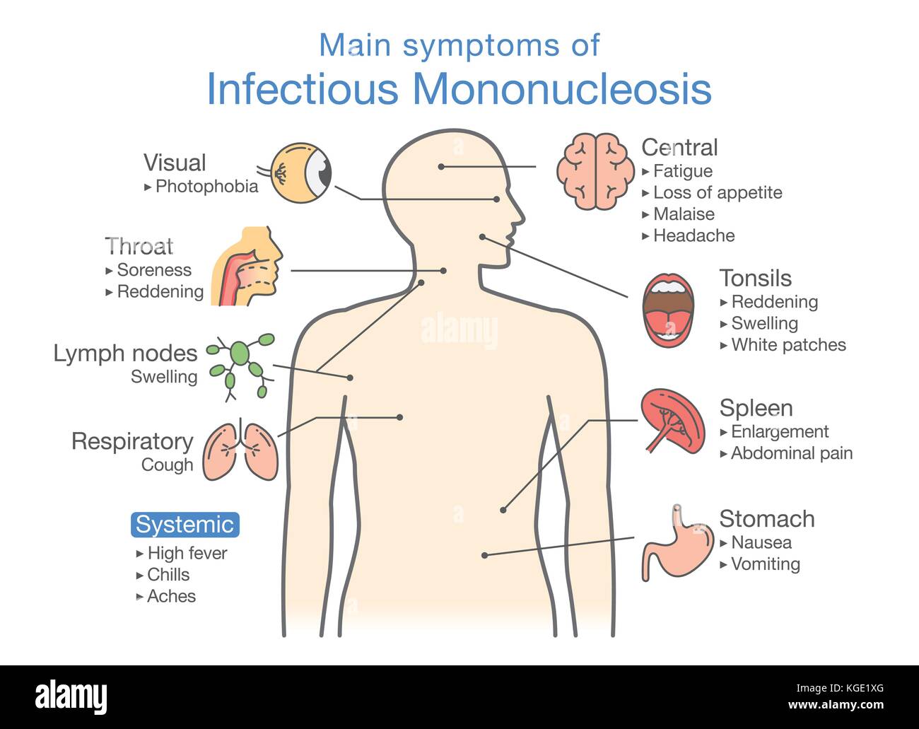 Symptoms of Infectious Mononucleosis disease. Stock Vector