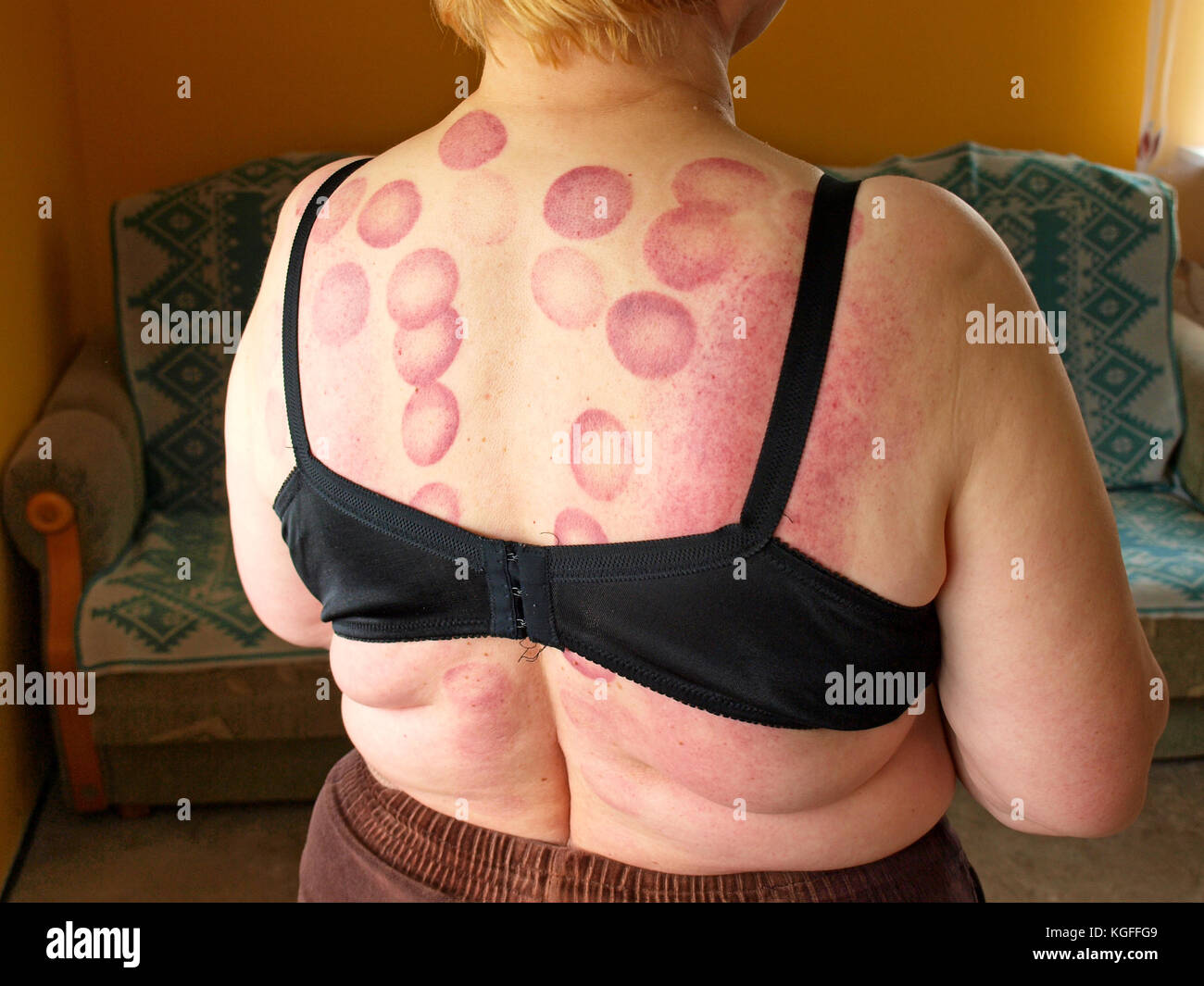 7 Signs a Skin Rash Could Indicate Something Serious