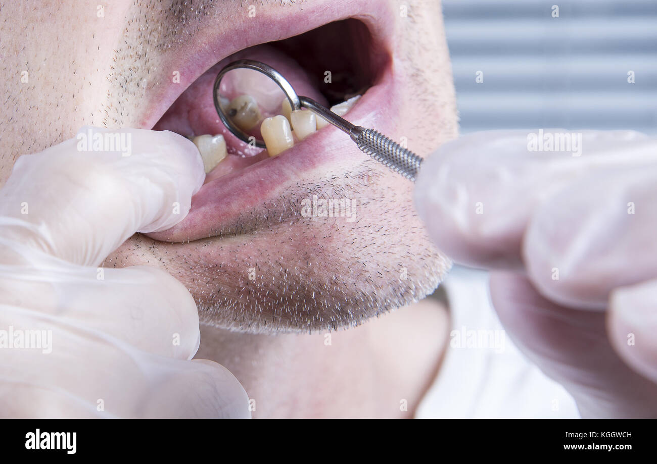 Closeup teeth, dental health care clinic with missing tooth Stock Photo