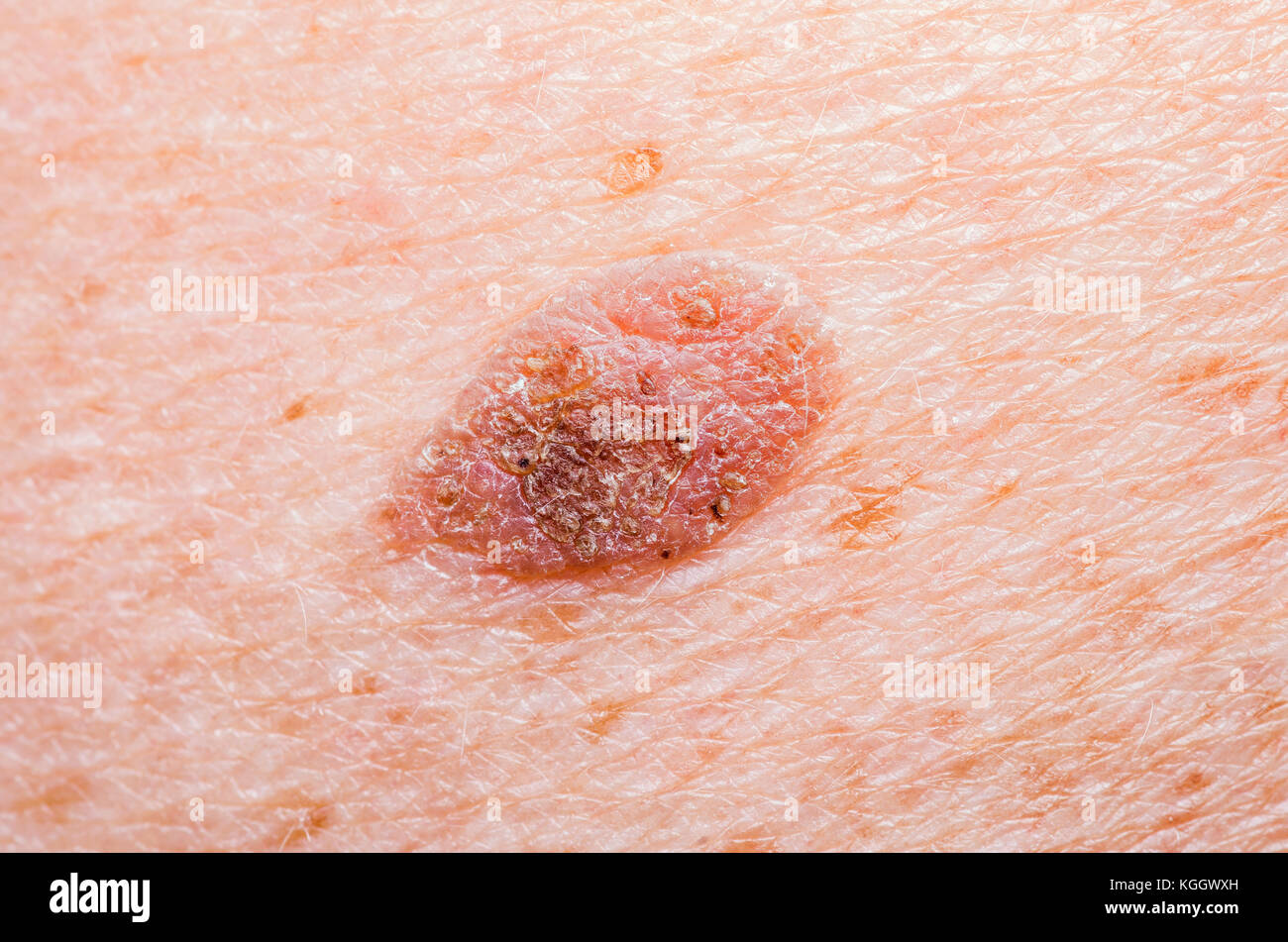Melanoma mole hires stock photography and images Alamy