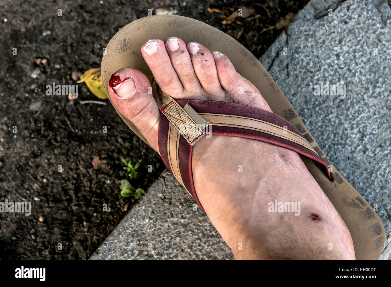 Accident flip flop cut foot nail toe have a bloody and bleeding wound from  injury after slipping Stock Photo - Alamy