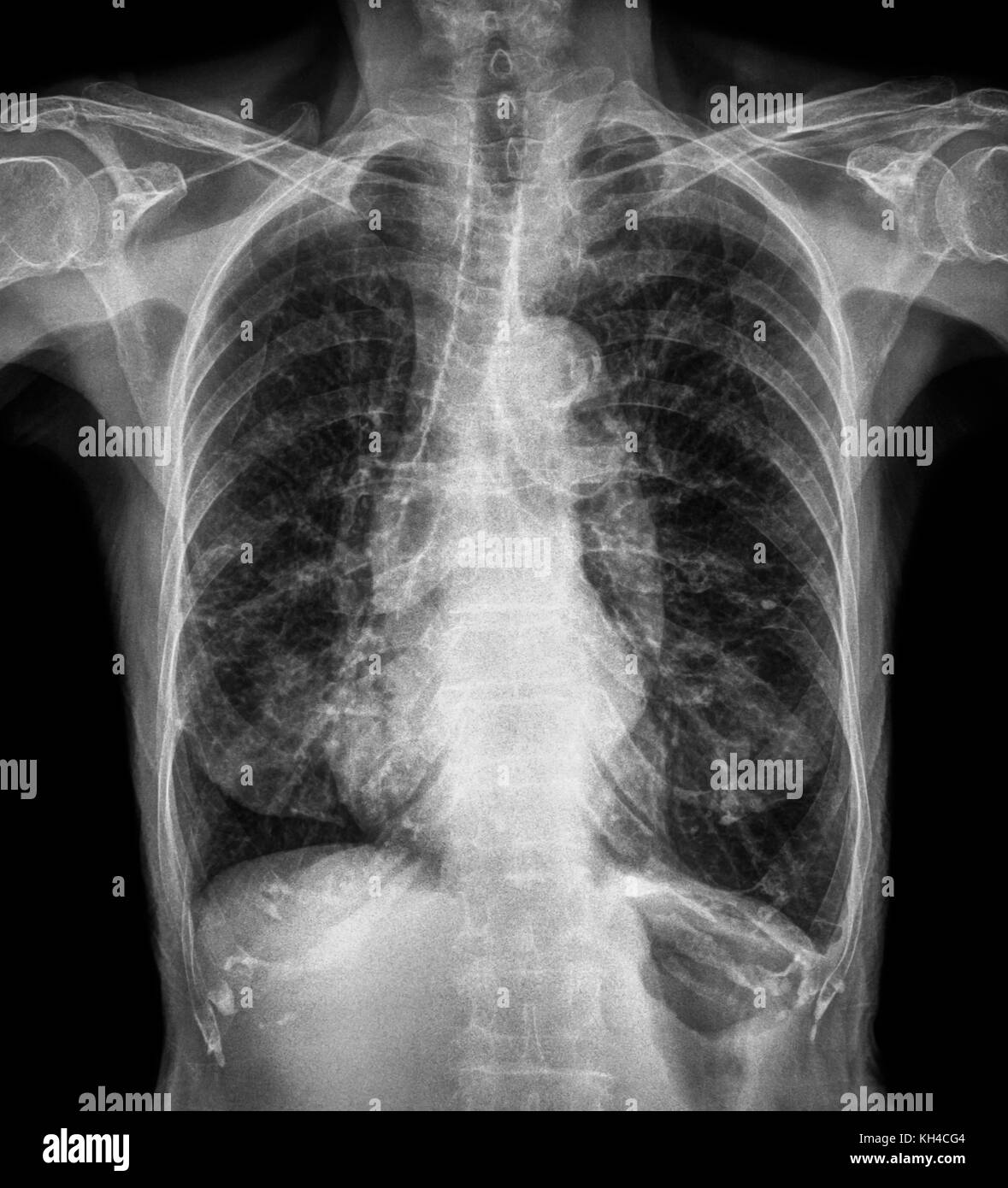 Normal chest Xray of old patient . You can seen calcification at rib