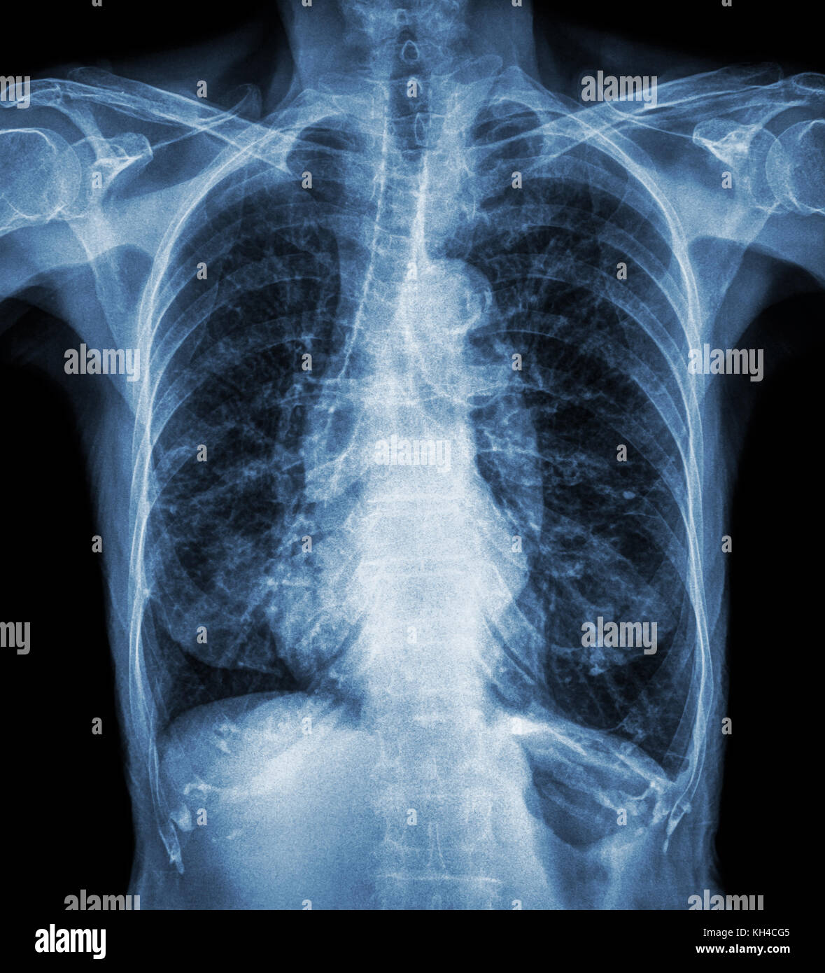 Normal chest X-ray of old patient . You can seen calcification at rib , trachea , bronchus . Front view . Stock Photo