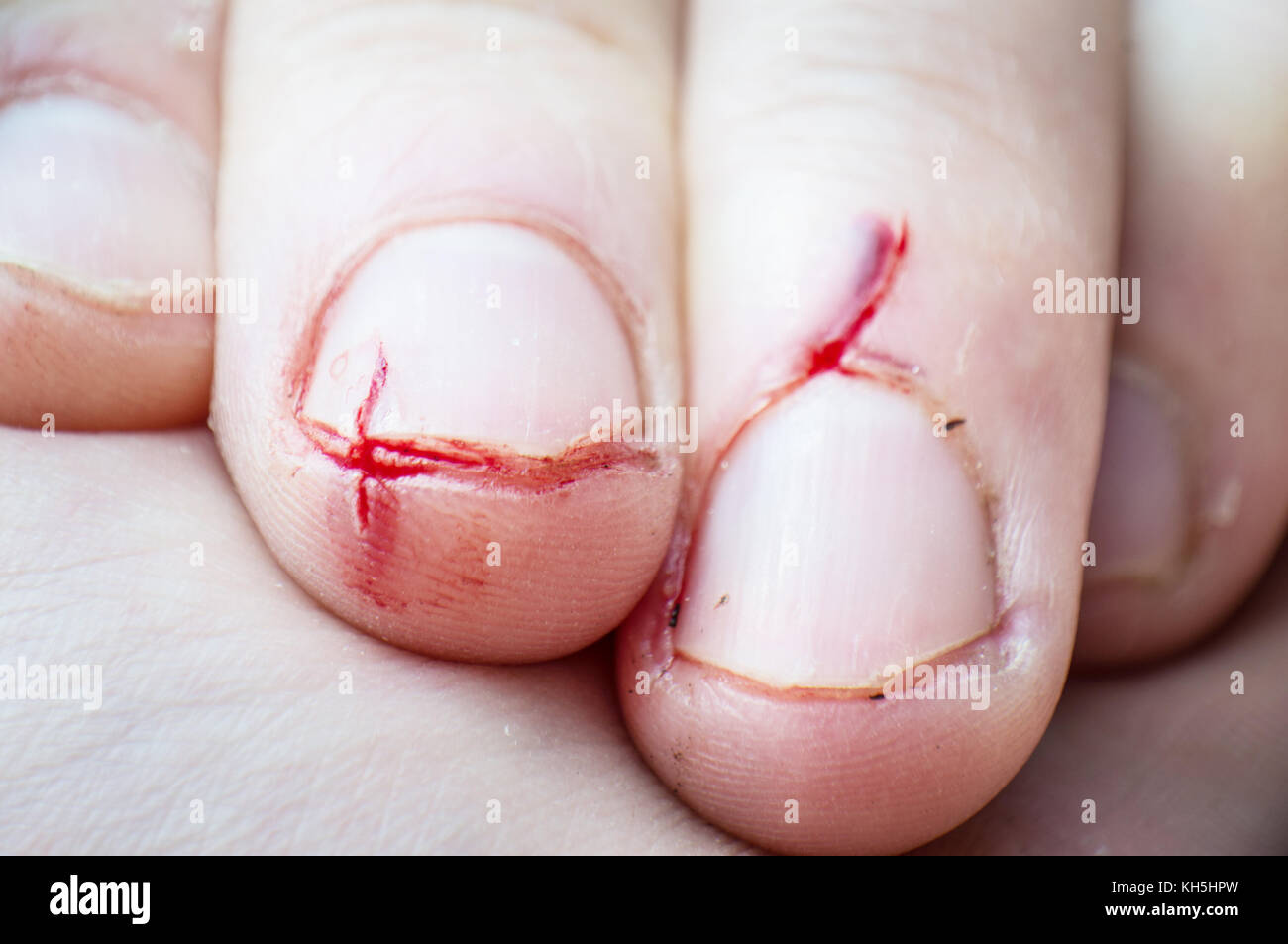 Brittle nails hires stock photography and images Alamy