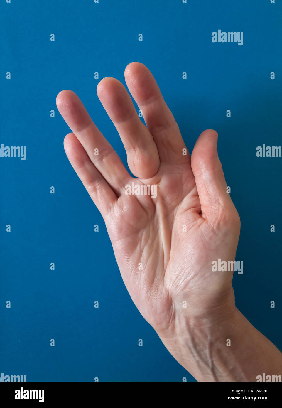 Dupuytren's Contracture deformity: a cord in the palm of hand (with a hard nodule at base of the middle finger) pulls finger into a bent position. Stock Photo