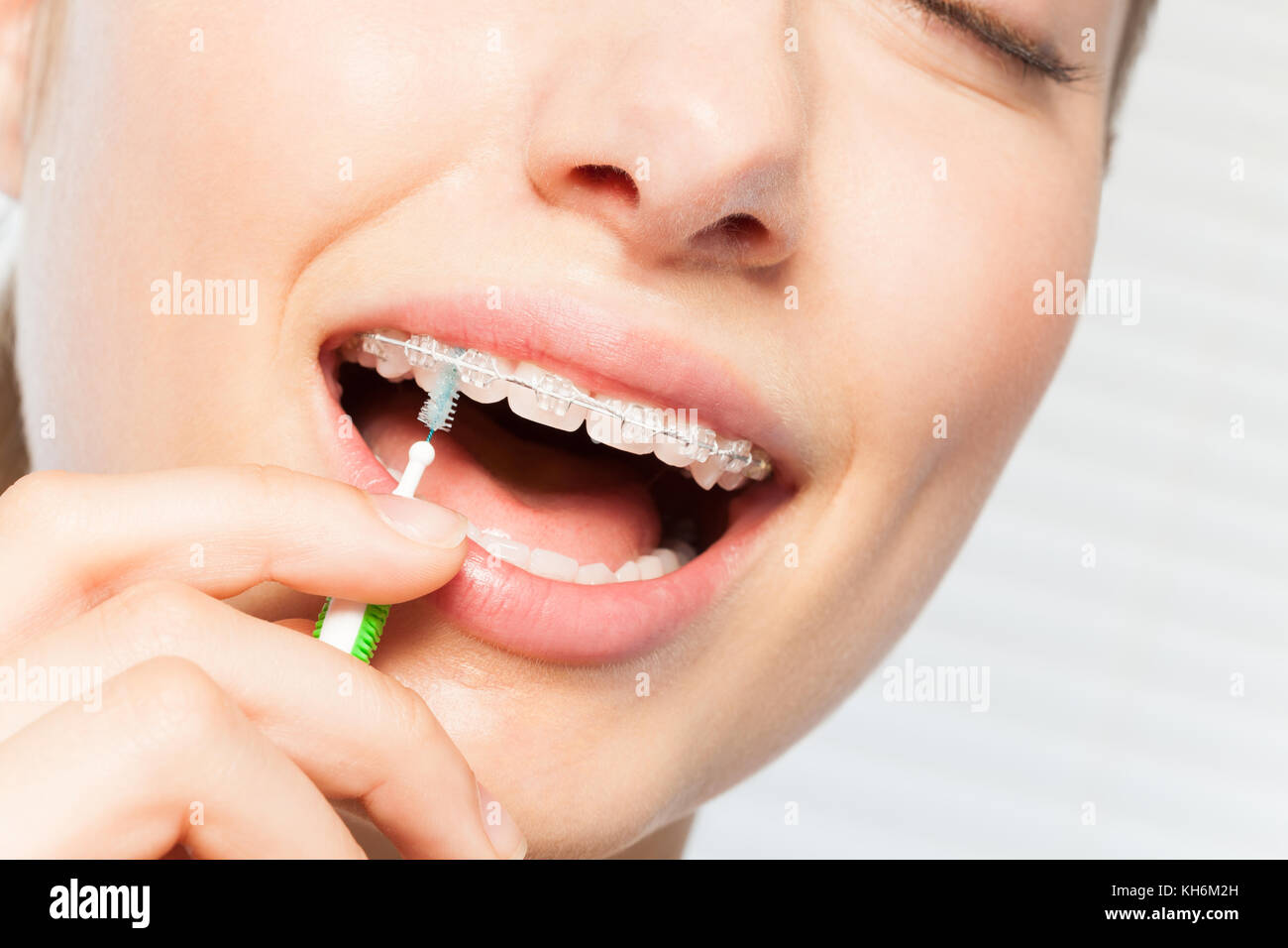 Man's mouth with braces and rubber correction strings on dental hooks  fixing position of teeth Stock Photo - Alamy