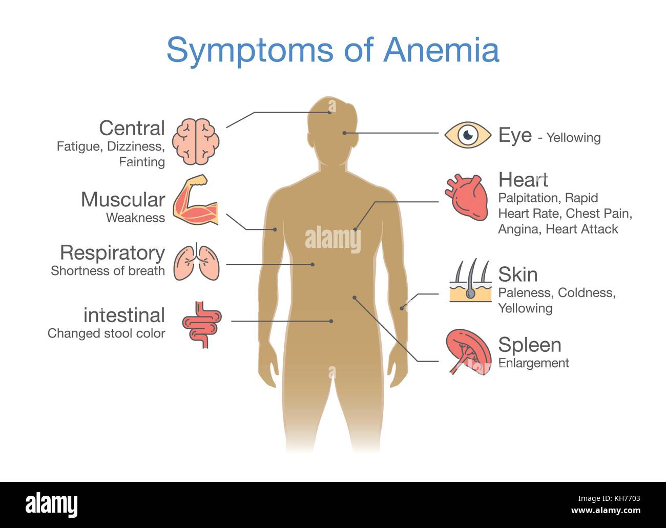 The most common Symptom of Anemia. Stock Vector