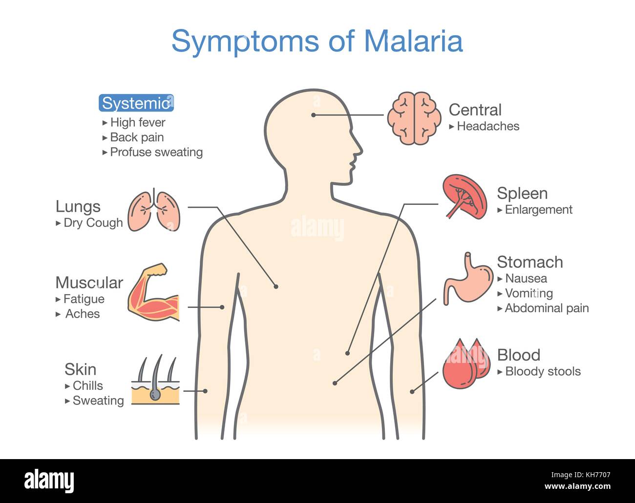 Diagram for patient with Malaria symptoms appear. Stock Vector