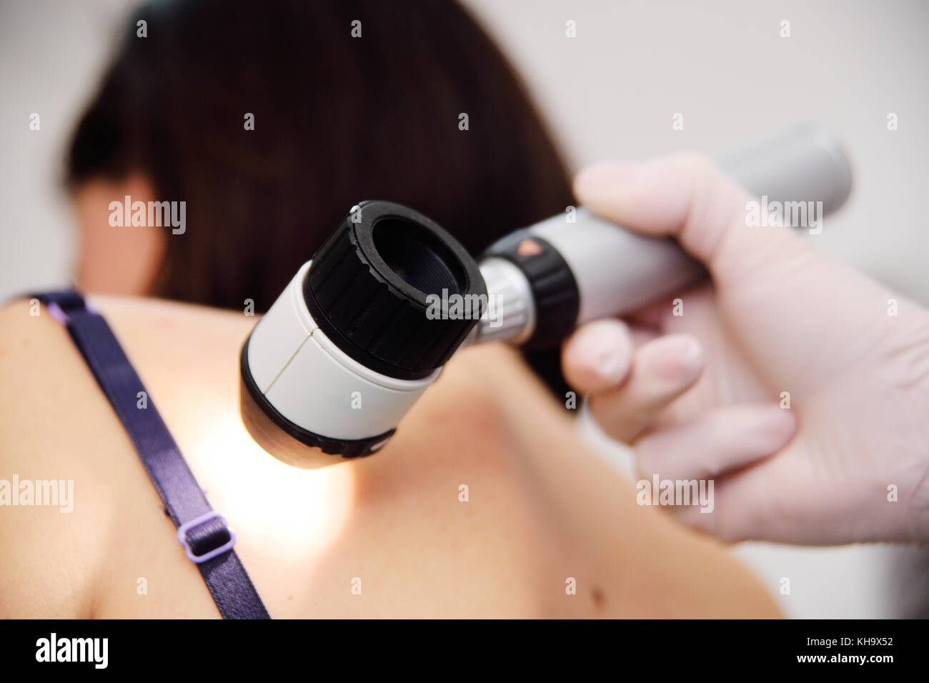 melanoma diagnoinspectionsis. the doctor examines the patient's mole Stock Photo