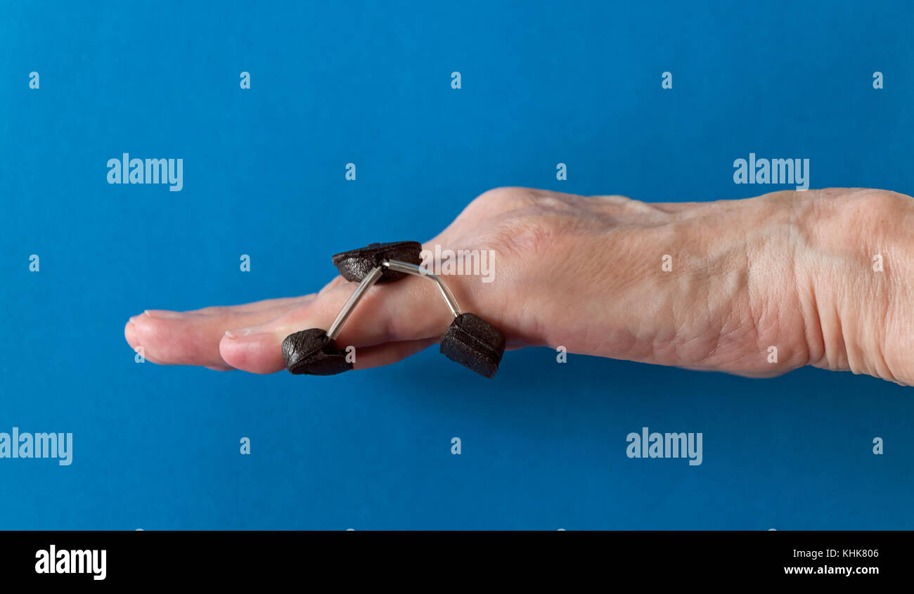 Finger splint on a little 'pinkie' finger after Dupuytren's Contracture corrective surgery to straighten finger and remove scar tissue. Stock Photo